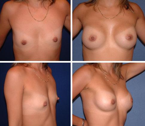 Aesth Plast Surg (2012) 36:331 338 337 Fig. 8 A 38-year-old woman with breast hypoplasia who requested breast augmentation. Left row: preoperative photos. Right row: postoperative photos.