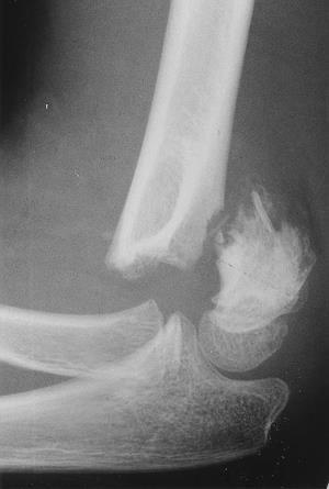 Median Nerve Lesion in Elbow Region Damaged in supracondylar fracture of humerus Muscles affected are: