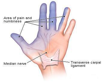 Carpal Tunnel Syndrome The commonest neurological problem associated with median nerve is compression beneath flexor retinaculum at wrist.