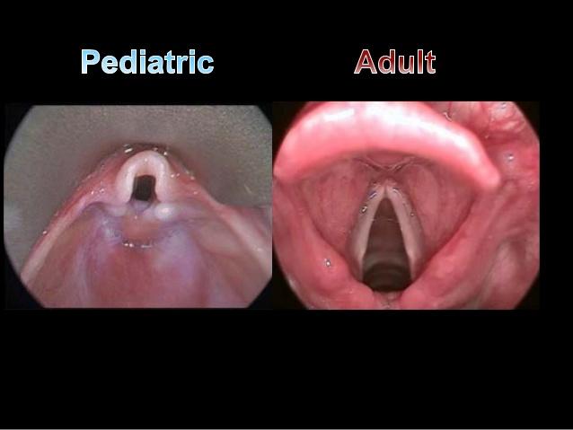 Differences Adult epiglottis broader, axis parallel to trachea Infant epiglottis omega (Ώ) shaped and angled away from axis of trachea More difficult to lift an infant s epiglottis with laryngoscope