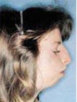 Treacher Collins Syndrome Mandibulofacial dysostosis Occurs in 1/10,000 births Cheek bone and jaw bone underdeveloped External ear anomalies,