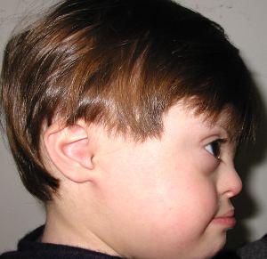 chronic pulmonary infection, seizures, and acute lymphocytic leukemia Atlanto-occipital dislocation can occur during intubation due to congenital