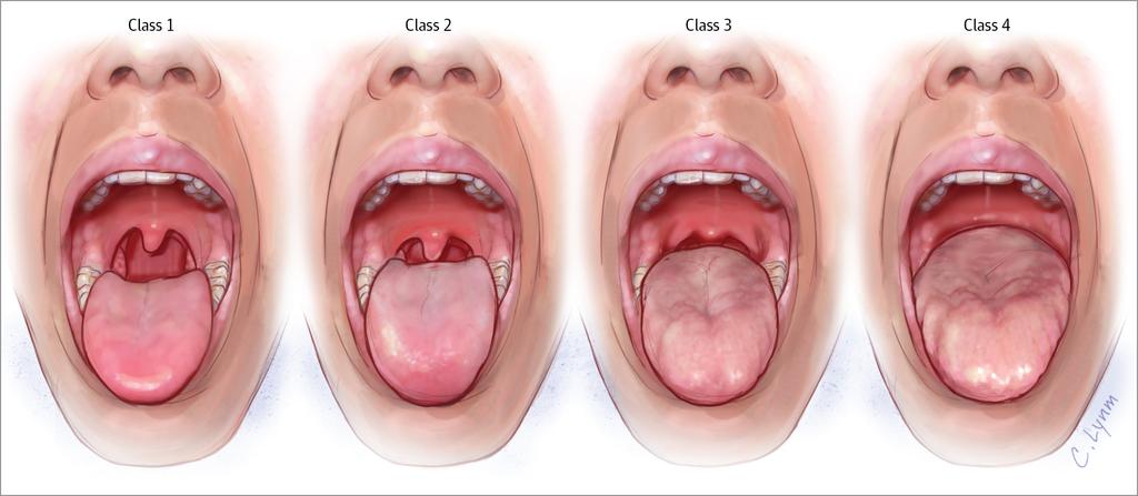 Airway masses (papillomas, tonsils, mediastinal) 4.