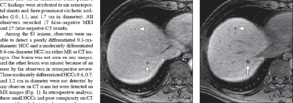Gadoxetic acid MRI better for small HCC Portal Venous
