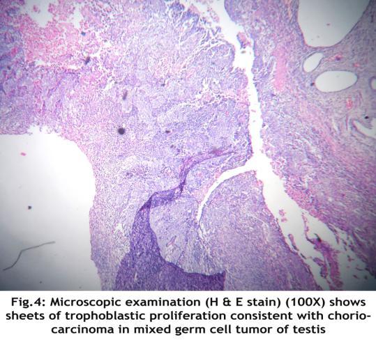 elements. Occasional foci show Schiller- Duval bodies (Fig-2). Foci of trophoblastic proliferation (Fig-4) and areas of necrosis were noted.