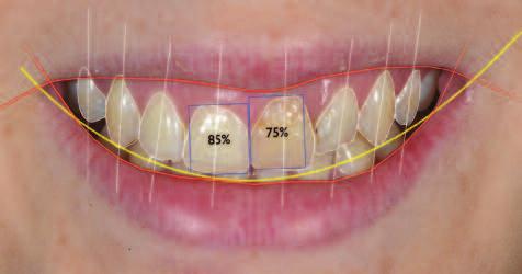 Once the picture was analysed it was obvious that her gingival display was clearly asymmetric with the gingival zeniths as well
