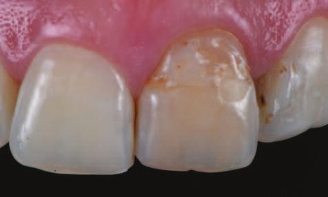 Tooth 21 is obviously discolored and, as well as tooth 22, shows