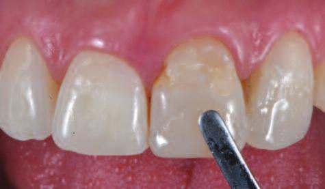 A direct mock-up with composite was made in order to check the right length and tooth proportions (Figure 15).