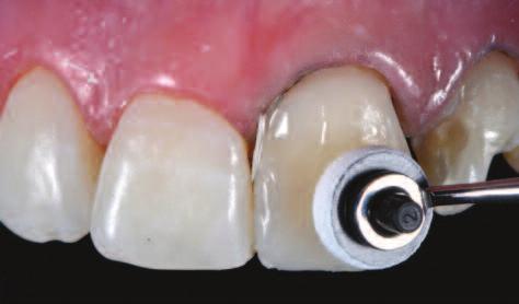 IPS Empress Direct Dentin Bleach L and Enamel Bleach L were placed with the help of a novel composite spatula