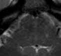 brain MRI