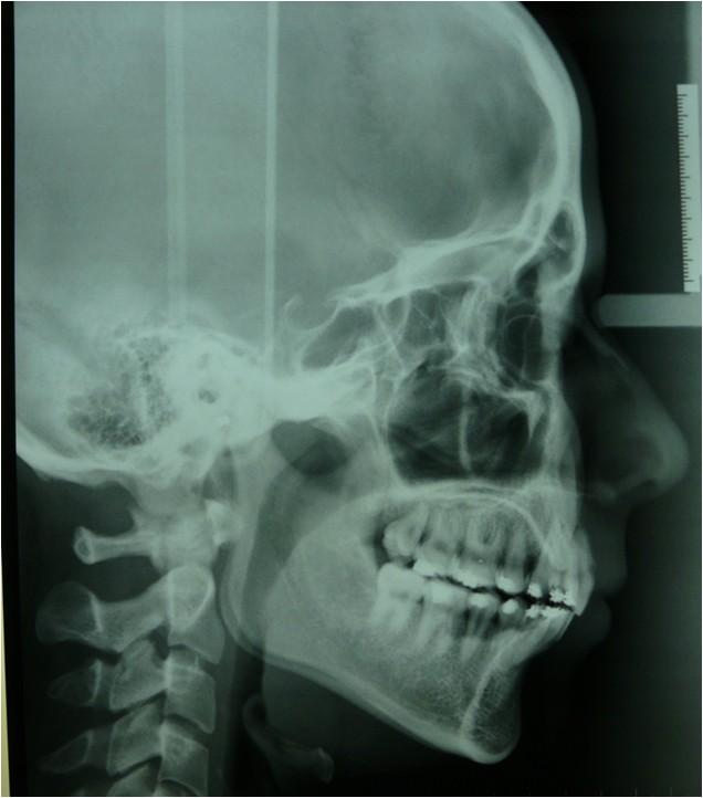 LATERAL SKULL RADIOGRAPH AT COMPLETION OF TREATMENT