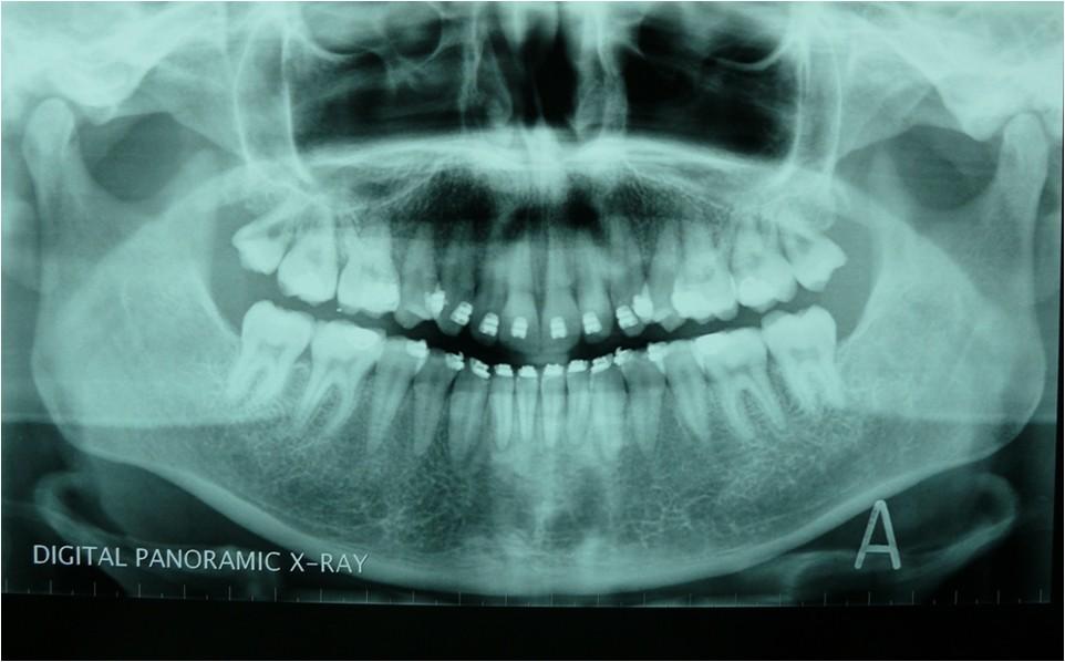 PERIAPICAL OR PANORAMIC RADIOGRAPHS AT COMPLETION OF TREATMENT