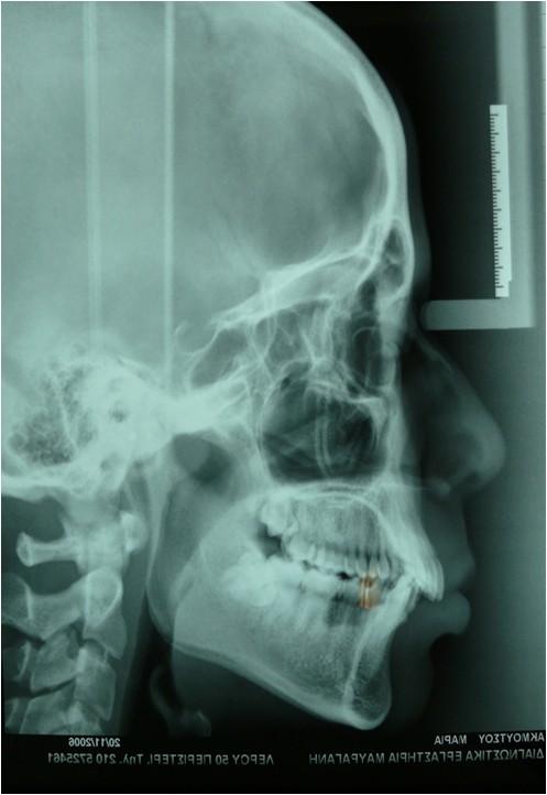LATERAL SKULL RADIOGRAPH BEFORE TREATMENT CANDIDATE