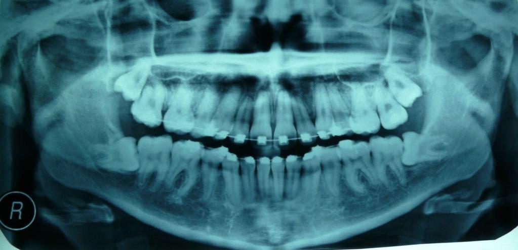 RADIOGRAPHIC ANALYSIS AT COMPLETION OF TREATMENT A. INTRAORAL / PANORAMIC RADIOGRAPH B.