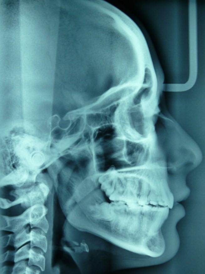 RADIOGRAPHIC ANALYSIS AT COMPLETION OF TREATMENT B. INTERPRETATION OF CEPHALOMETRIC ASSESSMENT 1) Normalization of Mandibular Inclination S-N/Go-Gn (34.
