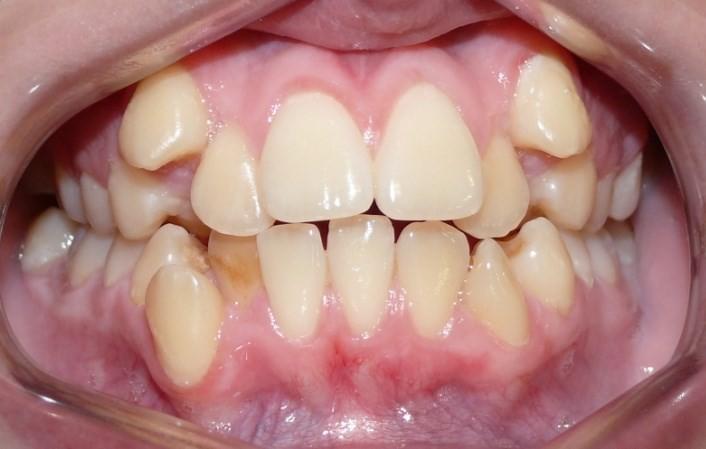 Mandibular teeth deviation to the right KANARELIS