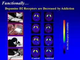 T Anhedonia The brain adapts to massive dopamine release by decreasing dopamine receptors In doing so, the brain becomes numb to natural rewards Brain adapts to experience Changes in receptors and