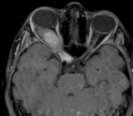 Craniopharyngeoma Hypothalamic