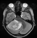frequently encountered posterior fossa tumor (30-35%) Peak incidence