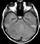 astrocytoma (WHO 1): Usually macrocystic with solid tumor nodule