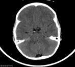 astrocytoma Follow up