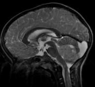 Brainstem glioma 2 nd /3 rd most frequent tumor, 20-25%