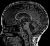 frequently, pilocytic astrocytoma Extend