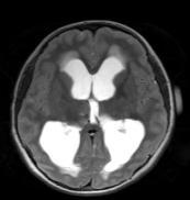 ICP due to obstructive hydrocephalus