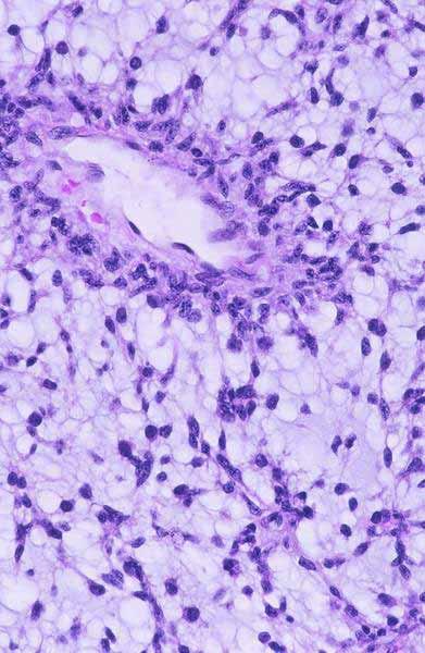 Pilomyxoid Astrocytoma WHO grade II entity that is clinically more aggressive than Pilocytic Astrocytoma Frequently involves