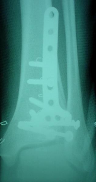 The strongest cancellous bone in the region of the distal tibia is located near the subchondral bone plate and may