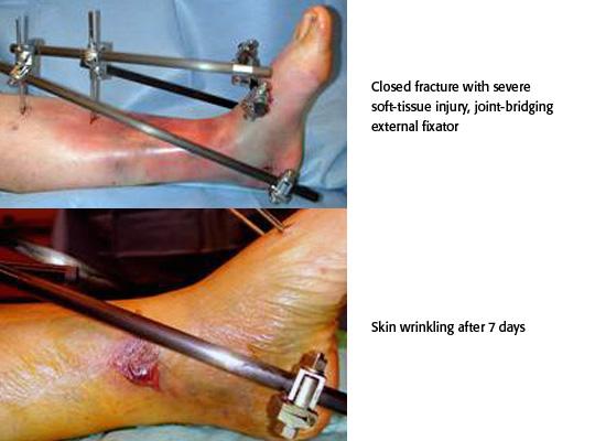 First stage: Closed reduction, fibular reduction and stabilization, and joint bridging external fixation.