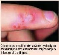 Herpetic whitlow Infection of the finger or nail area through small cuts Painful vesicular lesion of the finger then