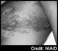 Varicella-Zoster Virus (VZV) Zoster means girdle, from the characteristic rash that forms a belt around the thorax Rash along dermatomes VZV- Pathology Trigeminal nerve reactivation uveitis,
