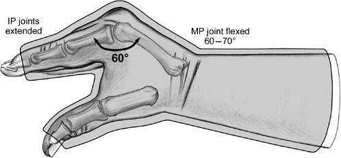 Managing a metacarpal X-ray to confirm fracture orientation Haematoma block 10mL of 1% lignocaine or 0.
