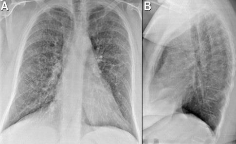 August 2018 Imaging Case of the Month: Dyspnea in a 55-Year-Old Smoker Michael B.