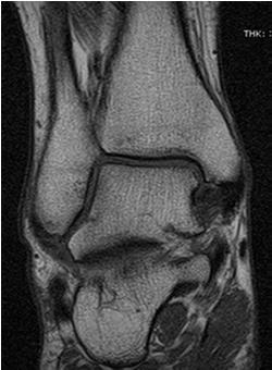 on MRI Tibial stress fracture