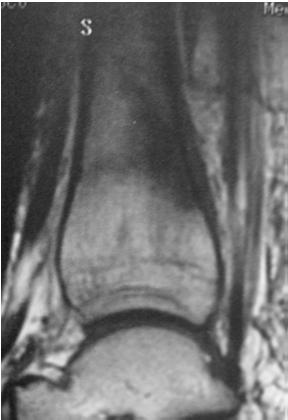 Medial-Tibial Stress Syndrome