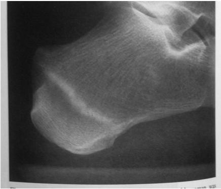 difficult healing, persistent nonunion, and risk for fracture displacement Surgery may be required for these and follow the same basic indications as for other fractures: nonunion, malunion,