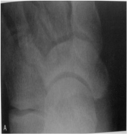 NAVICULAR STRESS FRACTURE Seen in active athletes involved in sprinting and jumping