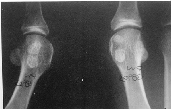 Bipartite sesamoid Fractured sesamoid 25 y/o female with patellofemoral pain after increased distance running 25 y/o female with mild patellofemoral