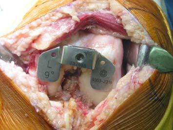 Then, use the 8 mm Twist Drill to create an opening in the femoral canal.