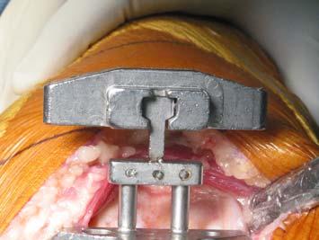 With T-handle removed, insert the Femoral Intramedullary Alignment Guide onto the Femoral IM Rod and advance the guide close contact with the distal femoral condyle(s).