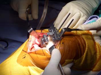 and attach the distal femoral cutting guide. Use two 3.2 mm twist drills to fix the distal femoral cutting guide.
