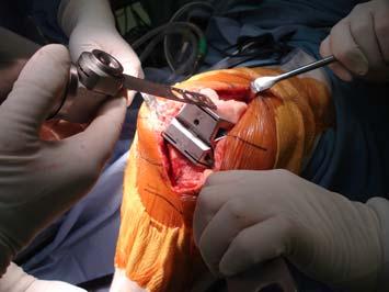 A/P and Chamfer Cutting Insert the chosen Femoral A/P Chamfer