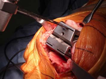 Nail the spike in the side holes of Femoral A/P Chamfer Cutting