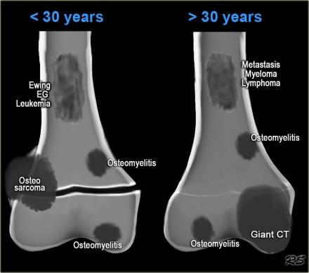 Bone tumor - ill defined osteolytic tumors and tumor-like lesions Henk Jan van der Woude and Robin Smithuis Radiology department of the Onze Lieve Vrouwe Gasthuis, Amsterdam and the Rijnland