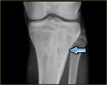 On the left an ill-defined osteolytic lesion in the proximal metaphysis of the tibia with extensive reactive sclerosis and solid periosteal reaction.
