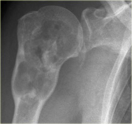 On the left a lobulated partially ill-defined lytic lesion of the proximal humerus. The presence of calcifications suggest that this is a chondroid tumor.