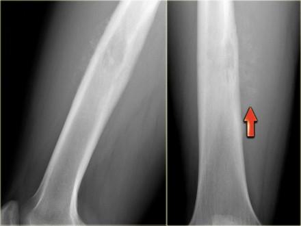 On the left an ill-defined lytic lesion in the femur of a young patient. There is a permeative destruction pattern with irregular cortical destruction.