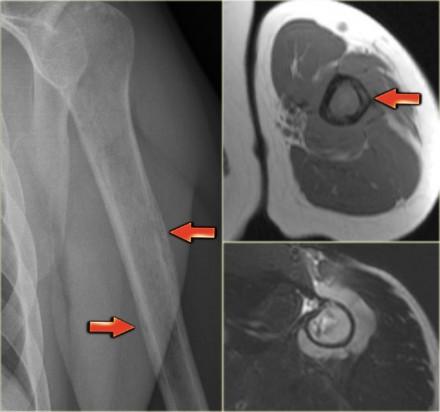 the differential diagnosis. On the left a giant cell tumor of the distal radius with ill-defined margins, destruction of the subchondral bone plate and extension towards the soft tissues.